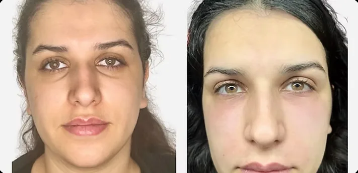 Laser skin resurfacing equipment used at Bellevue's top med spa.