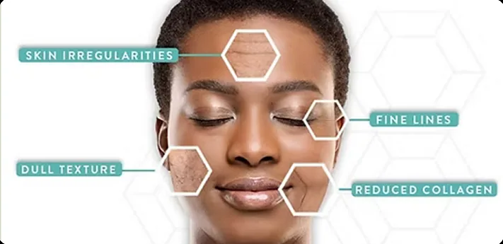 PRP facial therapy setup at Bellevue Natural Rejuvenation Med Spa.